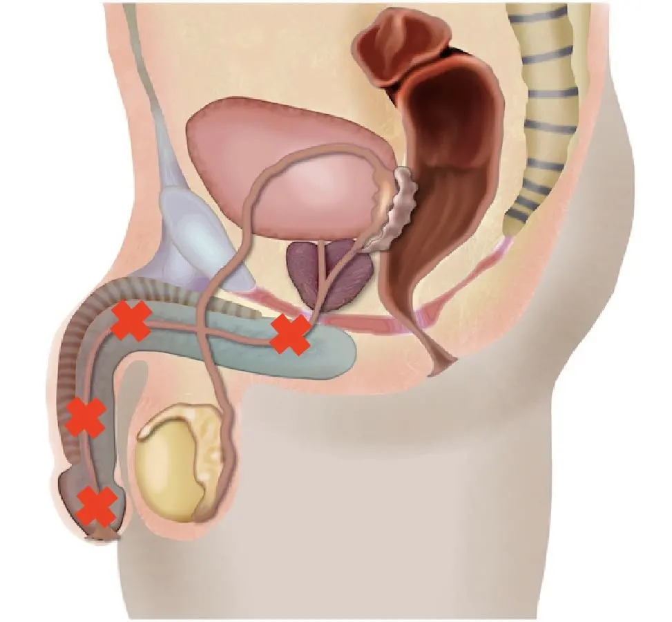 URETHRAL STRICTURE